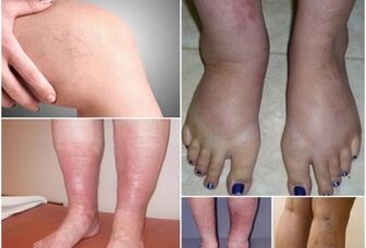 Foto manifestasi urat varikos pada kaki