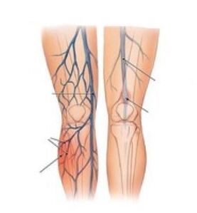 Trombosis vena memerlukan pembedahan