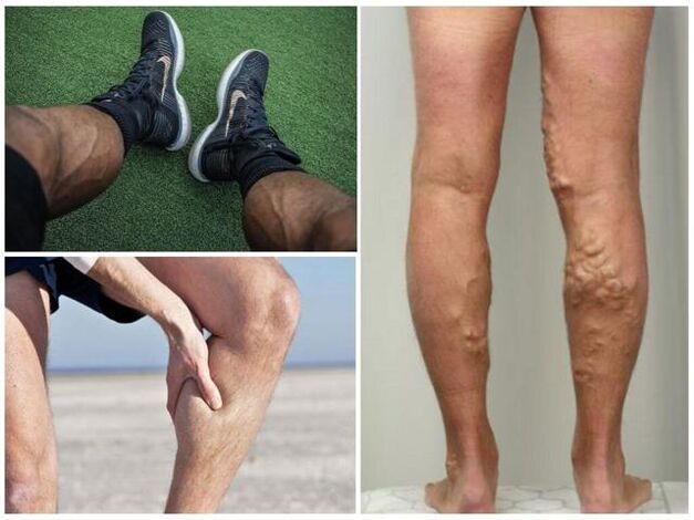 Apakah rupa urat varikos pada kaki lelaki