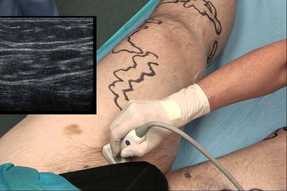 Diagnosis vena varikos pada lelaki