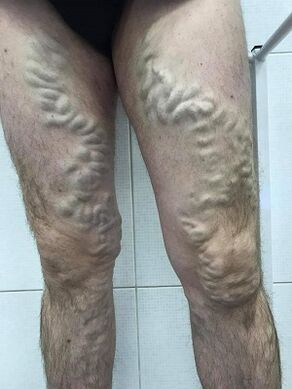 vena varikos lelaki yang diabaikan