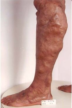 Manifestasi kekurangan vena kronik di bahagian bawah kaki