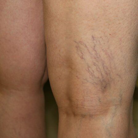 Rangkaian vena pada bahagian bawah kaki adalah tanda vena varikos