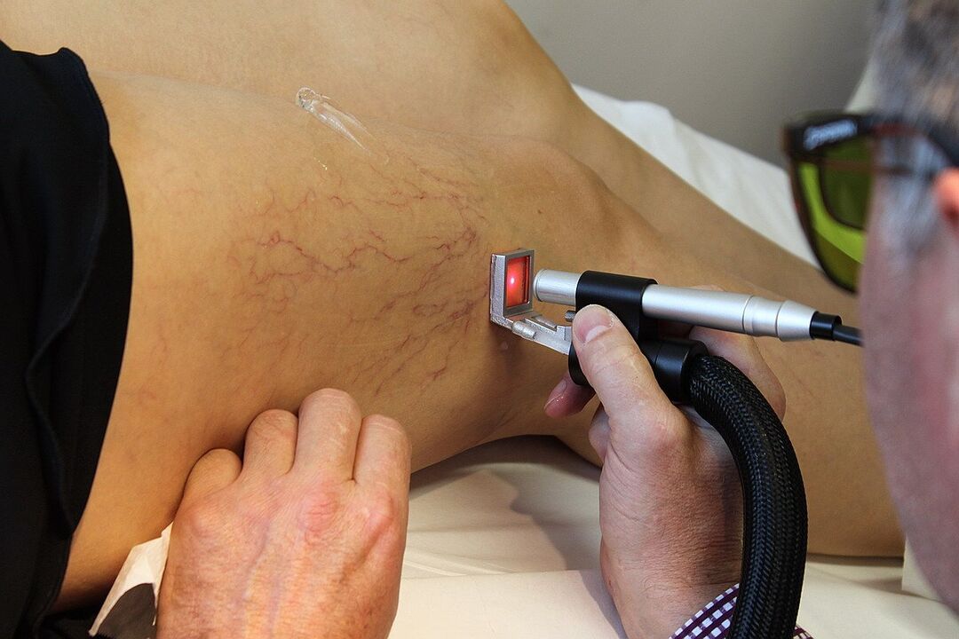Pembekuan laser