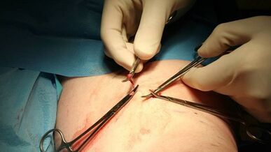 Flebectomy untuk urat varikos