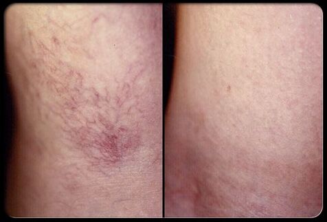 Sebelum dan selepas sclerotherapy